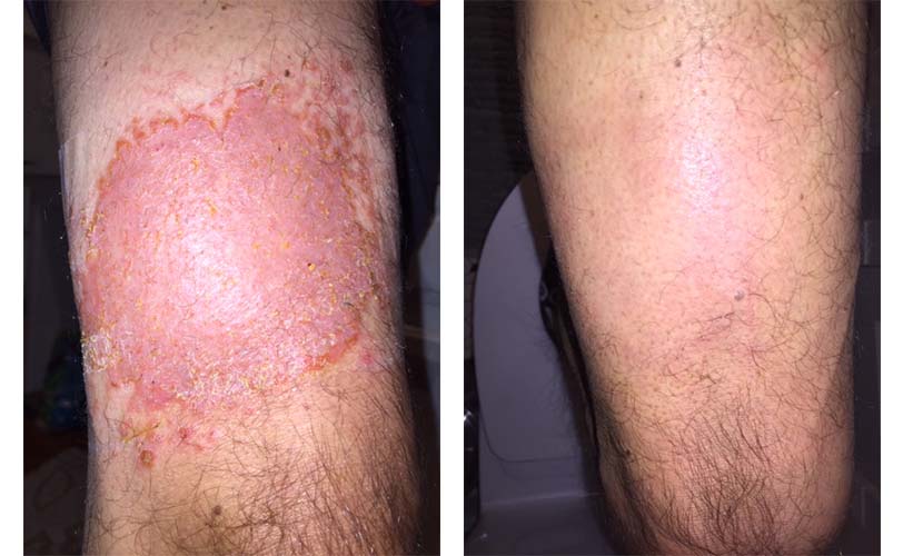 Fungal Infection Results